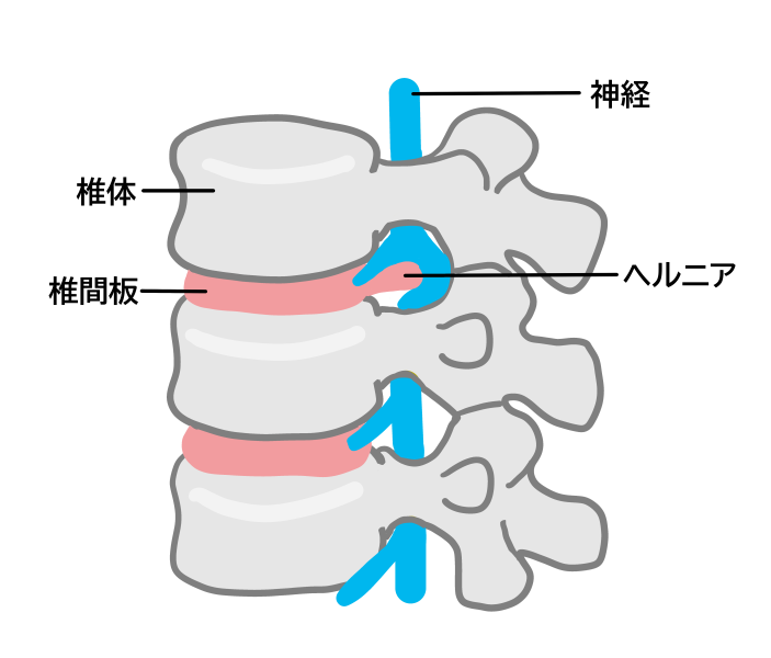 ヘルニアとは