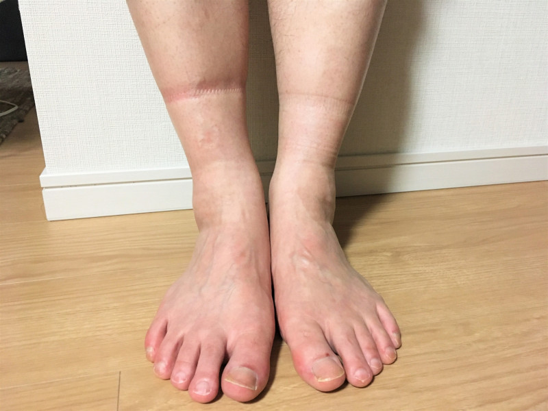 むくみのある女性